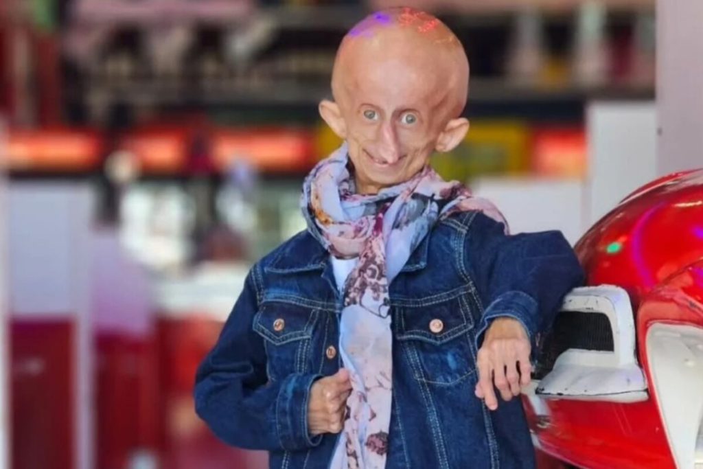 progeria1-1024x683 (1)